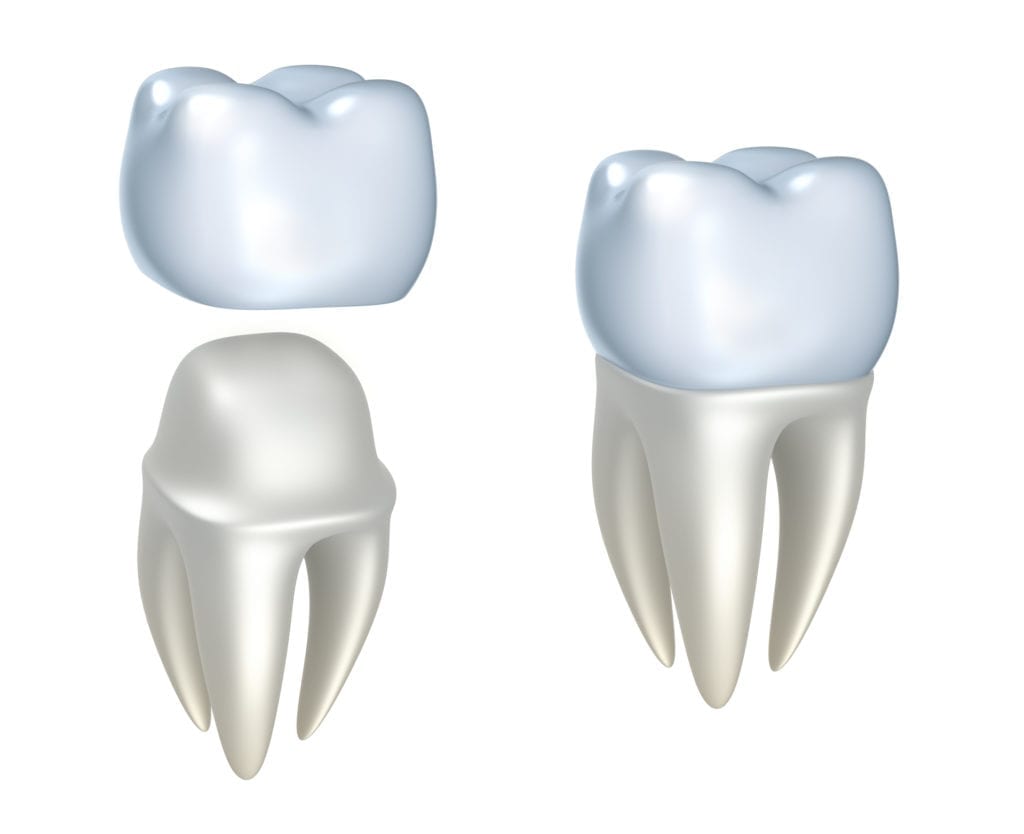 affordable dental crowns in Greeley Colorado