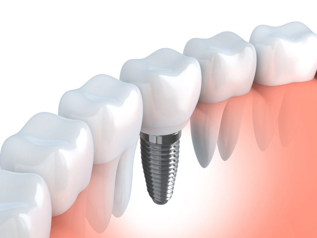 Dental Implants FAQs in Greeley, CO