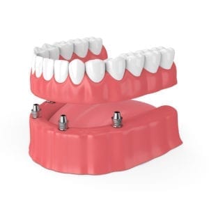 All-on-four implant denture in Greeley, CO
