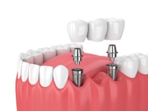 implant supported dental bridge evans co