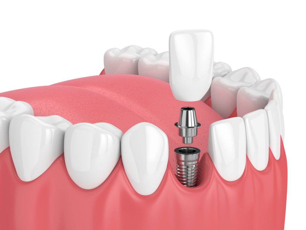 Dental Implants in Greeley, Colorado