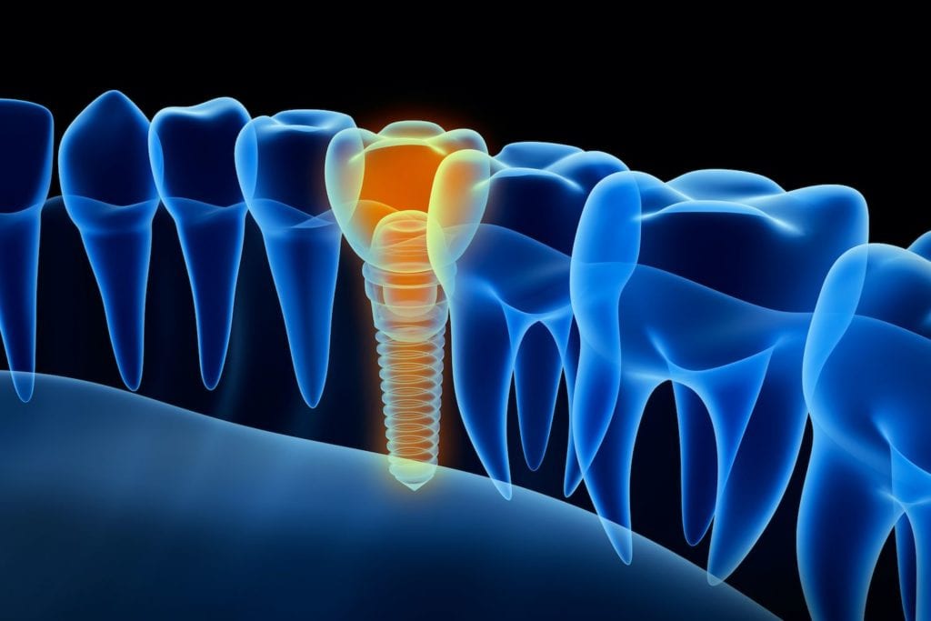 types of dental implants in Greeley Colorado