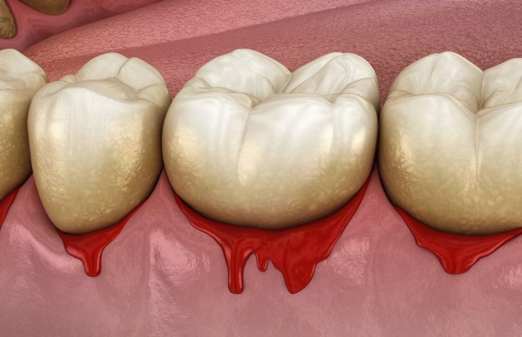 Treatment for bleeding gums in Greeley Colorado