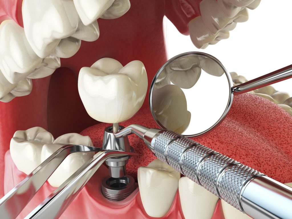 Dental Implant Recovery in Greeley CO