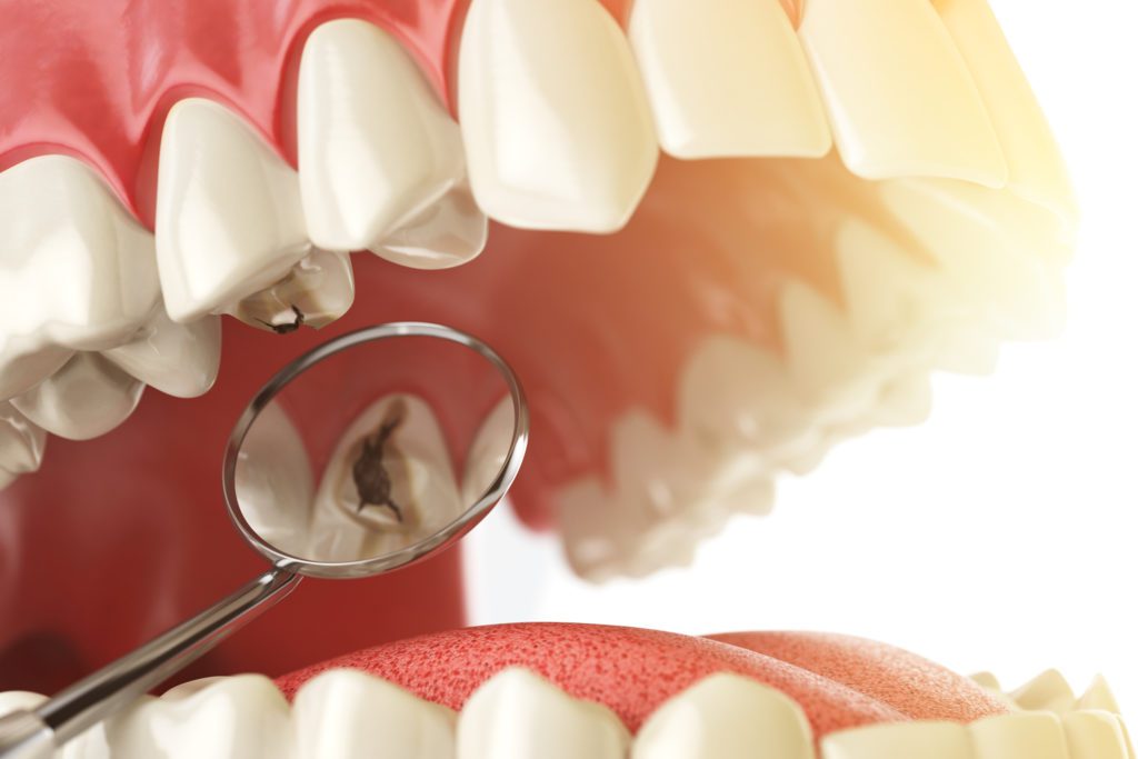 Treatment for Tooth Decay in Greeley CO