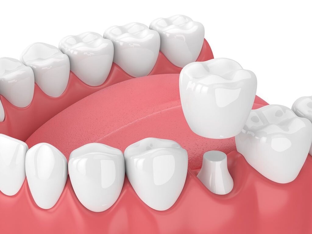 Benefits of Dental Crowns Greeley CO