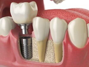 dental implants replace lost teeth after gum disease