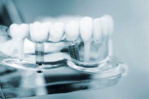 Dental Implants for Durable Tooth Replacement