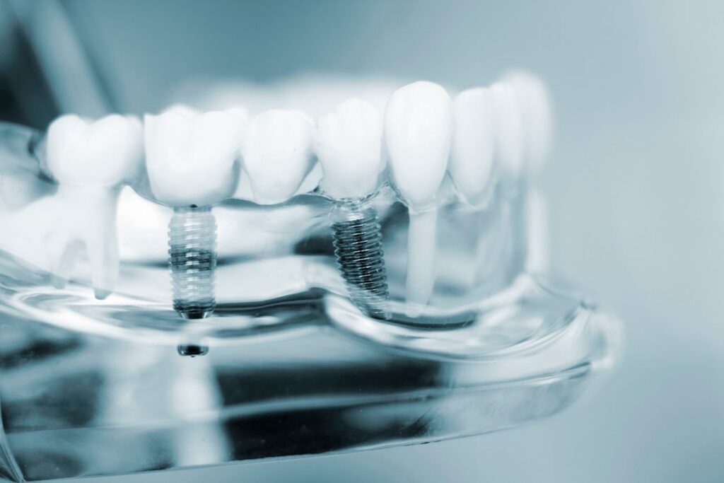 Durable Dental Implants Greeley CO