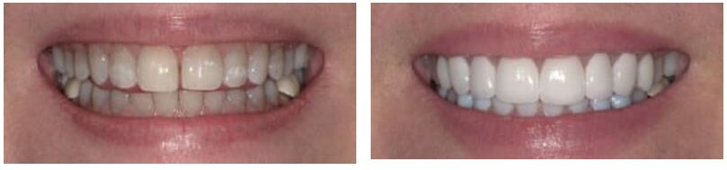 Patient before and after porcelain veneers in Greeley, CO