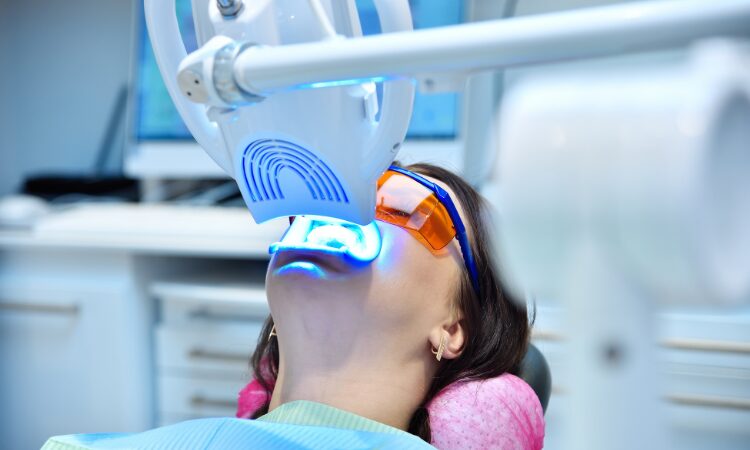 The Benefits of Professional Teeth Whitening