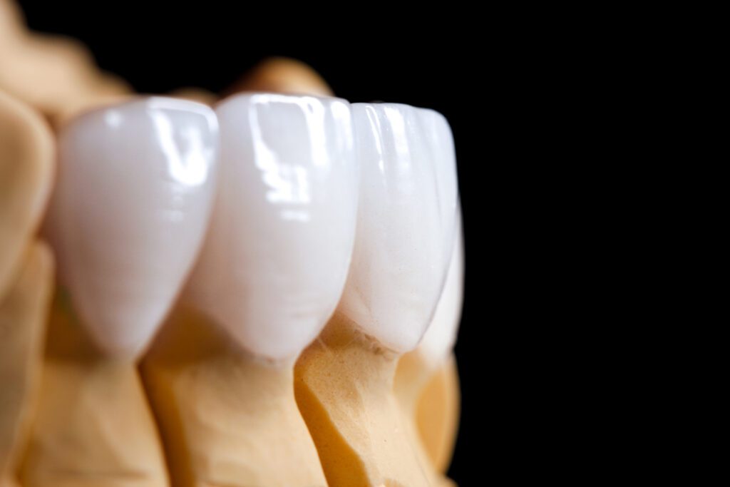 Dental Veneer Loveland CO