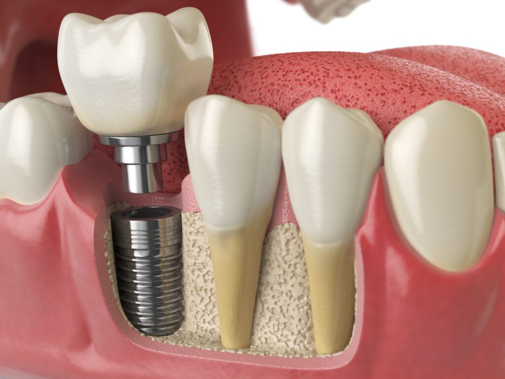 Dental Implants Plano TX